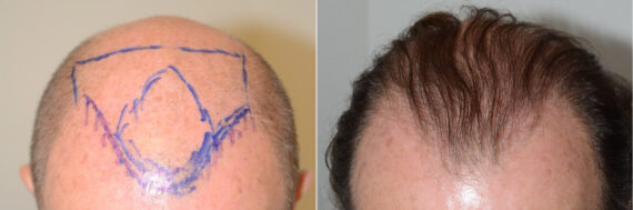 Hair Transplants for Men Before and after in Miami, FL, Paciente 60031