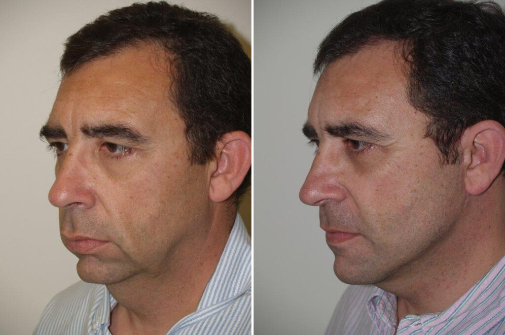 facial-plastic-surgery-photos-miami-fl-patient125668