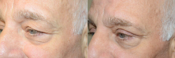 Facial Plastic Surgery Before and after in Miami, FL, Paciente 125679