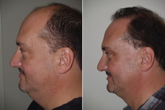 Facial Plastic Surgery Before and after in Miami, FL, Paciente 125706