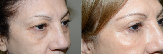 Facial Plastic Surgery Before and after in Miami, FL, Paciente 125783