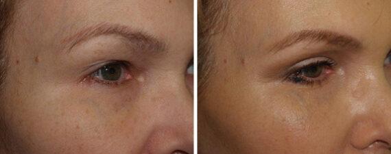 Facial Plastic Surgery Before and after in Miami, FL, Paciente 125864