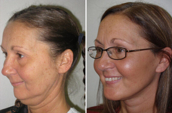 Facial Plastic Surgery Before and after in Miami, FL, Paciente 126014