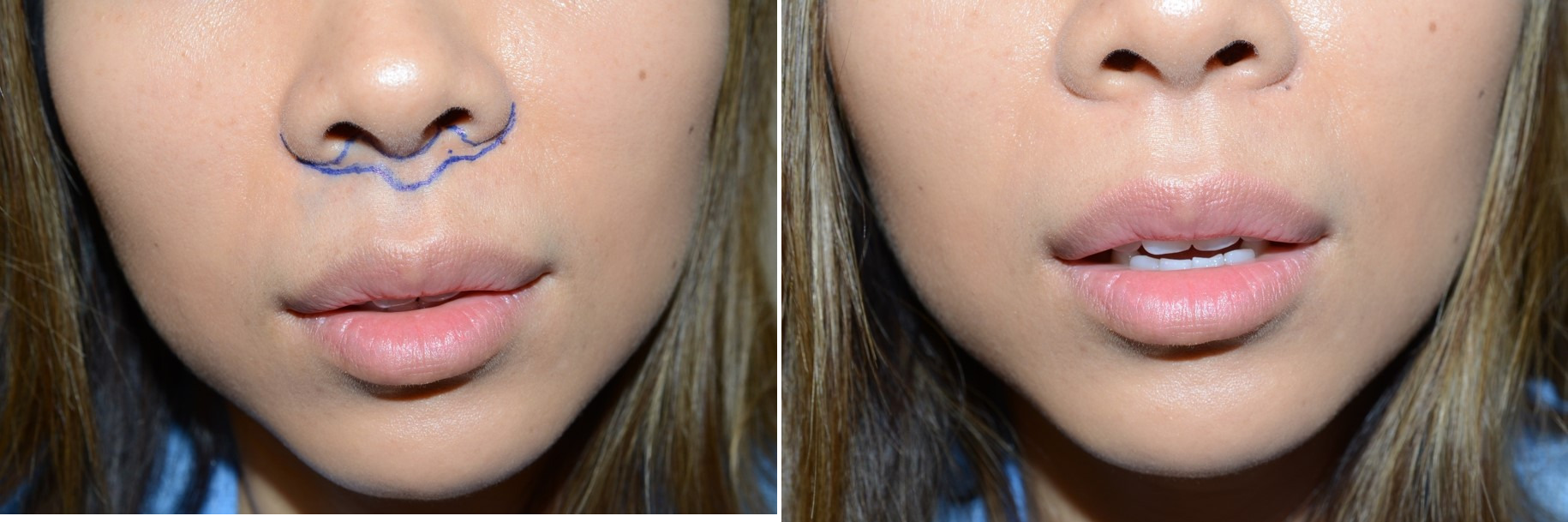 Lip Augmentation  South Florida Facial Plastic Surgery