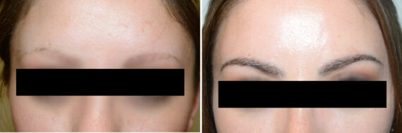 Eyebrow Hair Transplant Before and after in Miami, FL, Paciente 108278