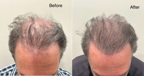 Scalp Micropigmentation Before and after in Miami, FL, Paciente 126166