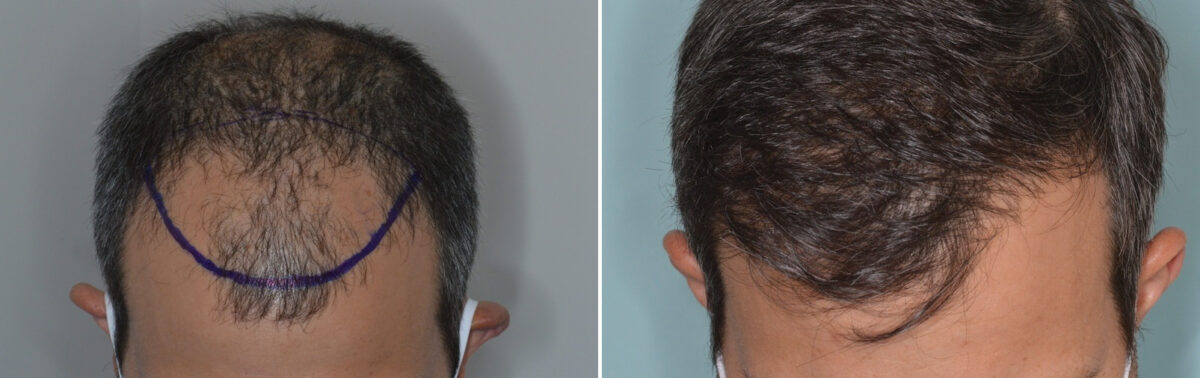Hair Transplants for Men Before and after in Miami, FL, Paciente 126399