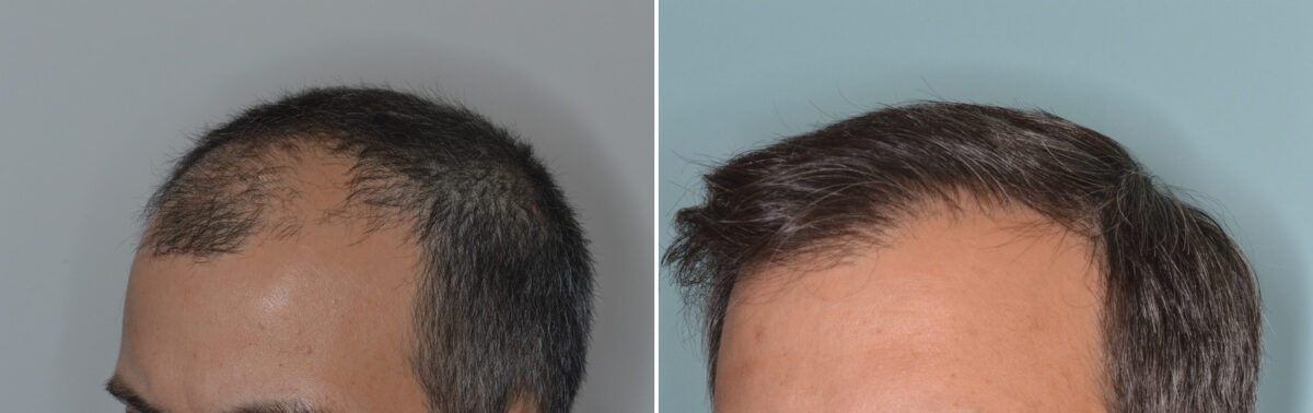 Hair Transplants for Men Before and after in Miami, FL, Paciente 126399