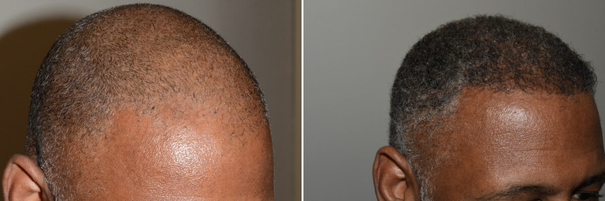 Hair Transplants for Men Before and after in Miami, FL, Paciente 126722