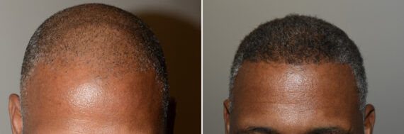 Hair Transplants for Men Before and after in Miami, FL, Paciente 126722