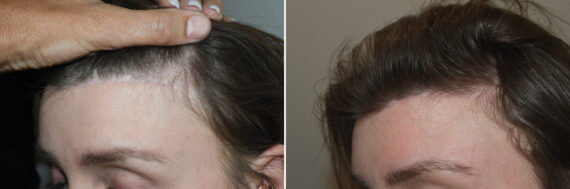 Forehead Reduction Surgery Before and after in Miami, FL, Paciente 126772