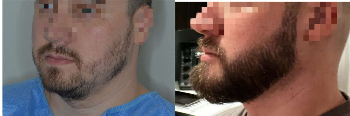 Facial Hair Transplant Before and after in Miami, FL, Paciente 126785