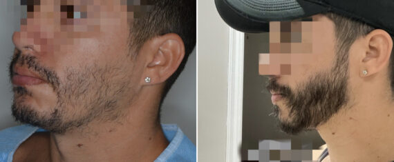 Facial Hair Transplant Before and after in Miami, FL, Paciente 126812
