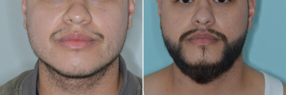 Facial Hair Transplant Before and after in Miami, FL, Paciente 126832
