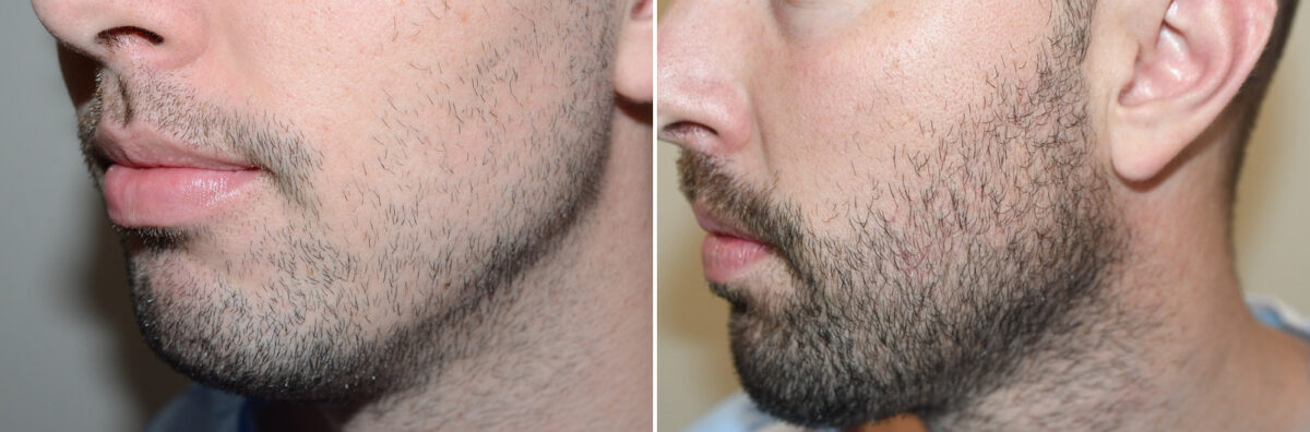 Facial Hair Transplant Before and after in Miami, FL, Paciente 126865