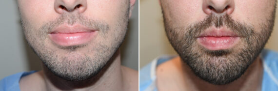 Facial Hair Transplant Before and after in Miami, FL, Paciente 126865