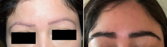 Eyebrow Hair Transplant Before and after in Miami, FL, Paciente 126884