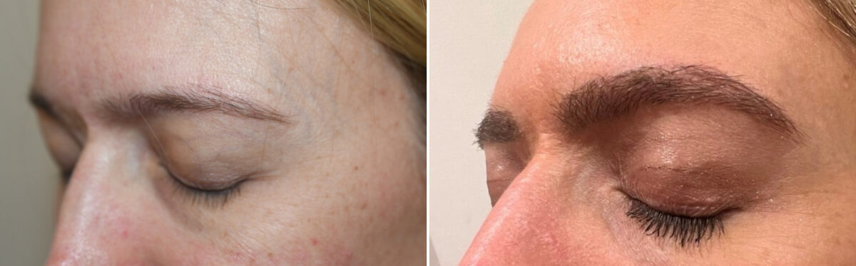 Eyebrow Hair Transplant Before and after in Miami, FL, Paciente 125878
