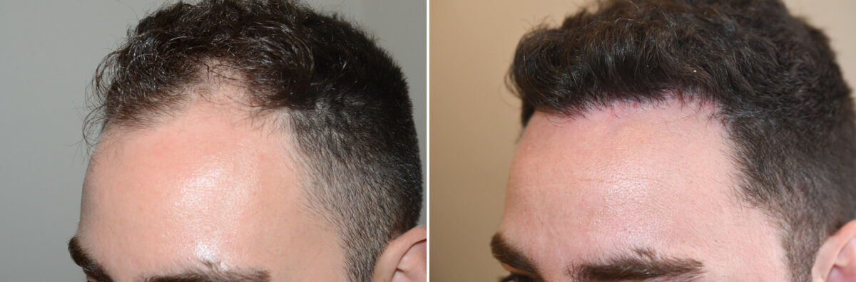 Hair Transplants for Men Before and after in Miami, FL, Paciente 126930