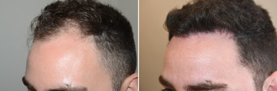 Hair Transplants for Men Before and after in Miami, FL, Paciente 126930