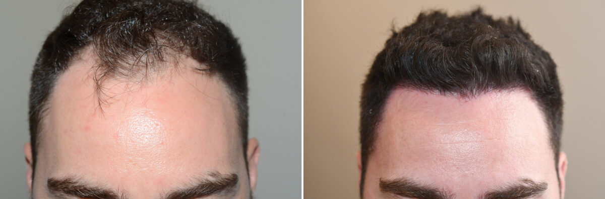 Hair Transplants for Men Before and after in Miami, FL, Paciente 126930