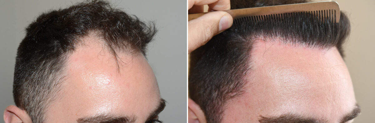 Hair Transplants for Men Before and after in Miami, FL, Paciente 126930