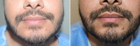 Facial Hair Transplant Before and after in Miami, FL, Paciente 126949