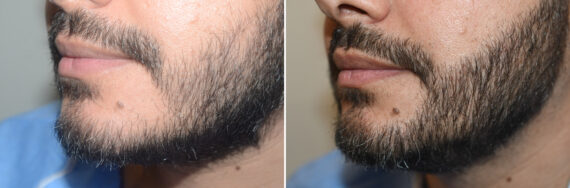 Facial Hair Transplant Before and after in Miami, FL, Paciente 126949