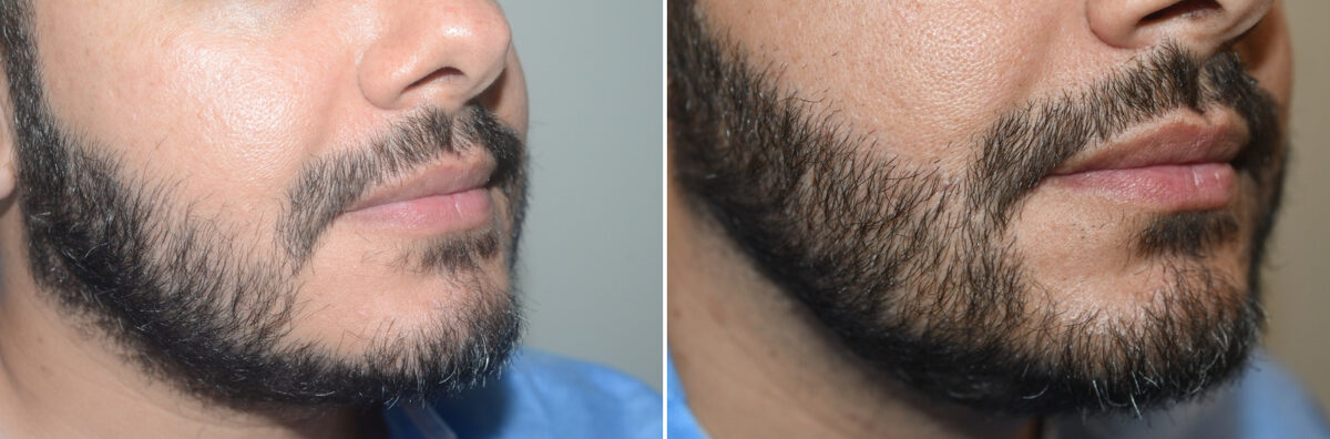 Facial Hair Transplant Before and after in Miami, FL, Paciente 126949