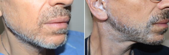 Facial Hair Transplant Before and after in Miami, FL, Paciente 126968