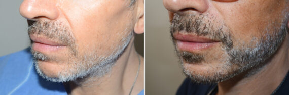 Facial Hair Transplant Before and after in Miami, FL, Paciente 126968
