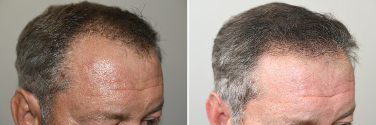 Hair Transplants for Men Before and after in Miami, FL, Paciente 126994