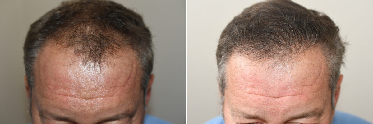 Hair Transplants for Men Before and after in Miami, FL, Paciente 126994