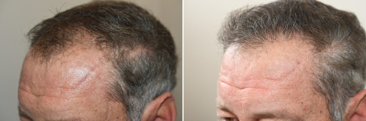 Hair Transplants for Men Before and after in Miami, FL, Paciente 126994