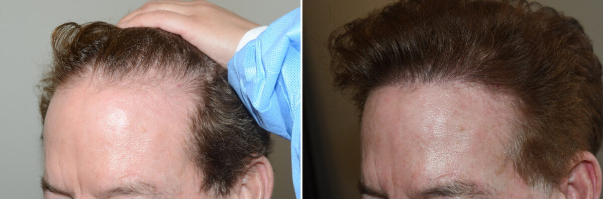 Hair Transplants for Men Before and after in Miami, FL, Paciente 127013