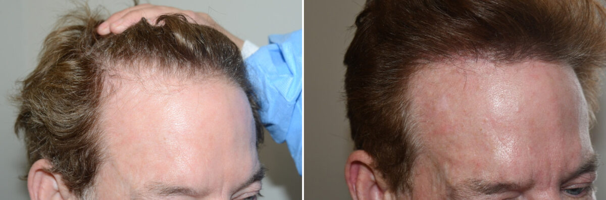 Hair Transplants for Men Before and after in Miami, FL, Paciente 127013