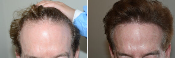 Hair Transplants for Men Before and after in Miami, FL, Paciente 127013