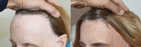 Forehead Reduction Surgery Before and after in , , Paciente 127051