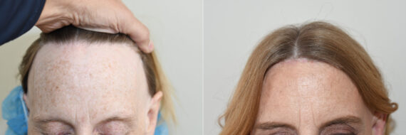 Forehead Reduction Surgery Before and after in , , Paciente 127051