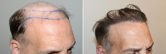 Hair Transplants for Men Before and after in Miami, FL, Paciente 127065