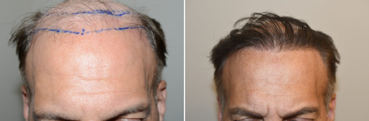 Hair Transplants for Men Before and after in Miami, FL, Paciente 127065