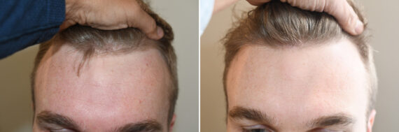 Hair Transplants for Men Before and after in Miami, FL, Paciente 127078