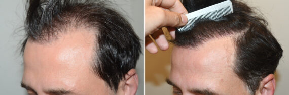 Hair Transplants for Men Before and after in Miami, FL, Paciente 127091