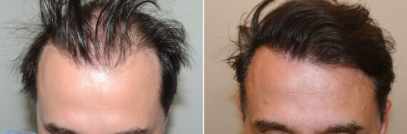 Hair Transplants for Men Before and after in Miami, FL, Paciente 127091
