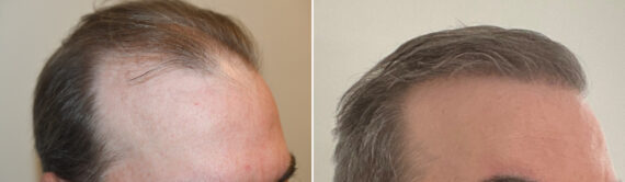 Hair Transplants for Men Before and after in Miami, FL, Paciente 127104