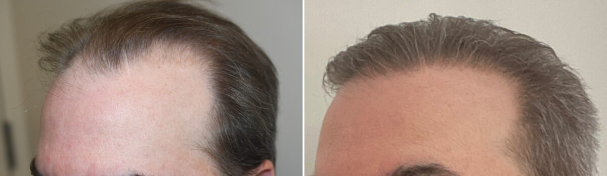 Hair Transplants for Men Before and after in Miami, FL, Paciente 127104