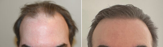 Hair Transplants for Men Before and after in Miami, FL, Paciente 127104