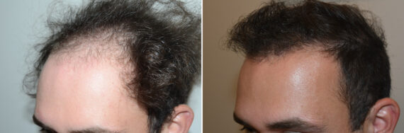 Hair Transplants for Men Before and after in Miami, FL, Paciente 127123