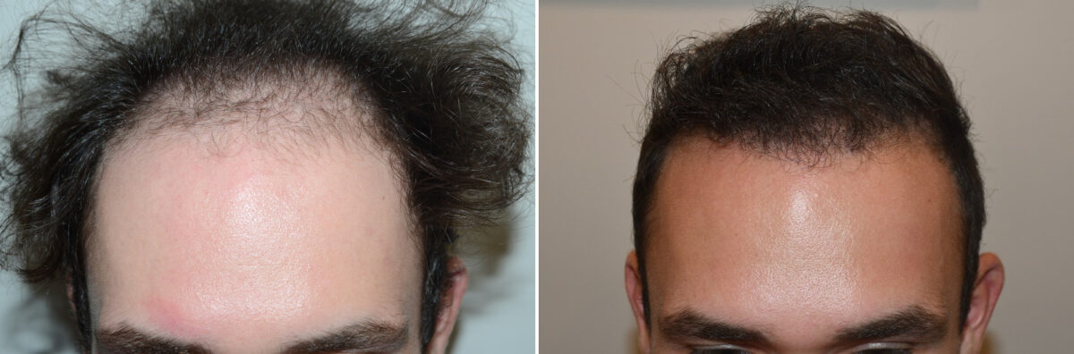 Hair Transplants for Men Before and after in Miami, FL, Paciente 127123