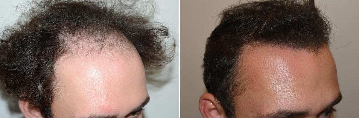 Hair Transplants for Men Before and after in Miami, FL, Paciente 127123